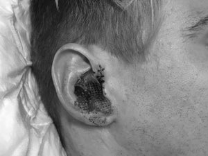 The Harsh Reality Of Surfers Ear (Exostosis).